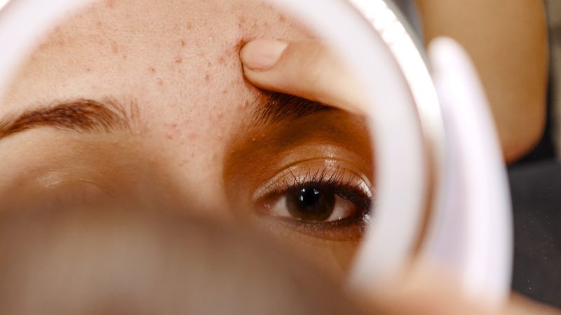 The perfect Options For Using Acne Cream