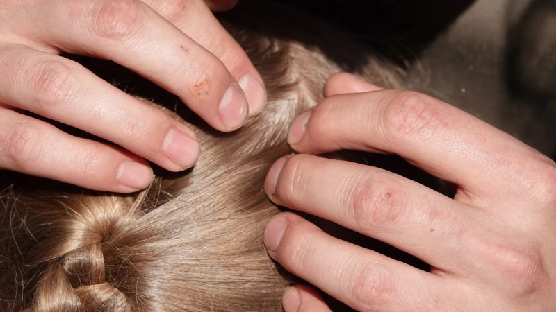 The Real Solutions for the Pimples on Scalp